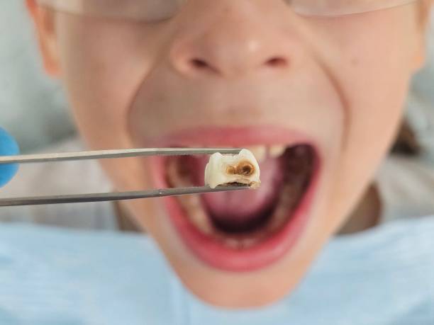 Best Emergency Dental Extractions in Little Elm, TX